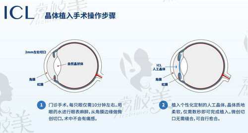 北京爱尔英智眼科医院周继红医生做晶体植入技术好
