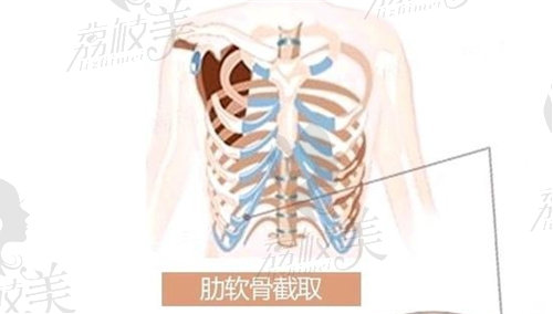 廣州可玉醫(yī)療美容醫(yī)院肋軟骨隆鼻價(jià)格不貴