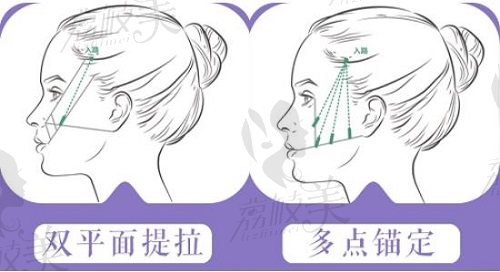 北京脸部筋膜提升医院排名前十