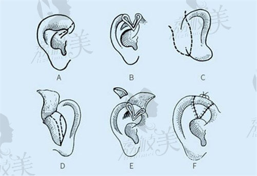 广州高尚医学美容中心耳再造怎么样