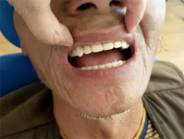 老人无牙牙床萎缩吸附式假牙