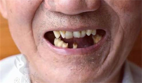 牙周刮治可以固定牙齿吗