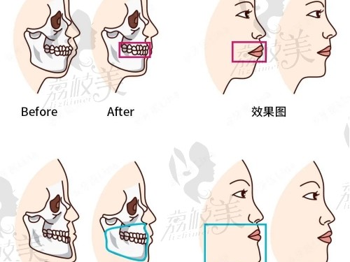 骨性凸嘴有必要整牙吗?