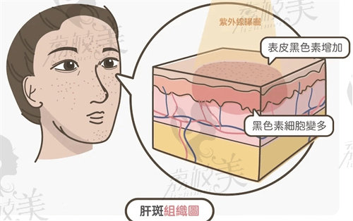 昆明博美时代黄褐斑研究院治疗黄褐斑多少钱