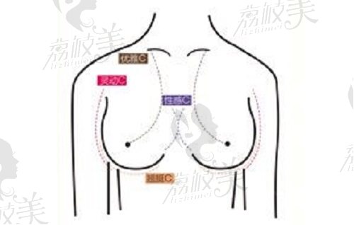 北京美莱高超医生隆胸整形技术