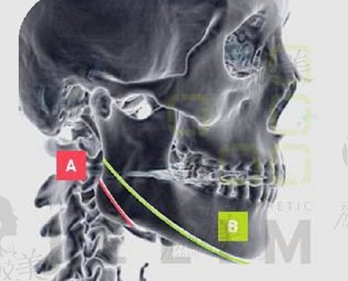 长曲线下颌角截骨术