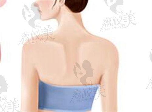 玻尿酸注射直角肩的原理及维持时间