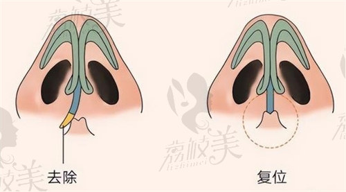 上海歪鼻整形医院哪家比较好？