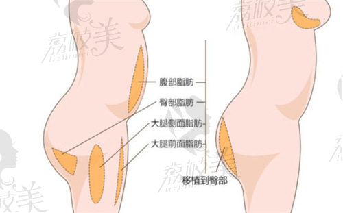 廣東豐臀整形醫(yī)院哪家好