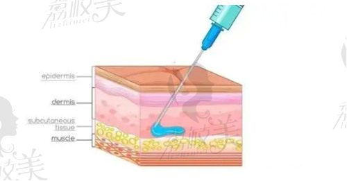 廣東玻尿酸除皺價格