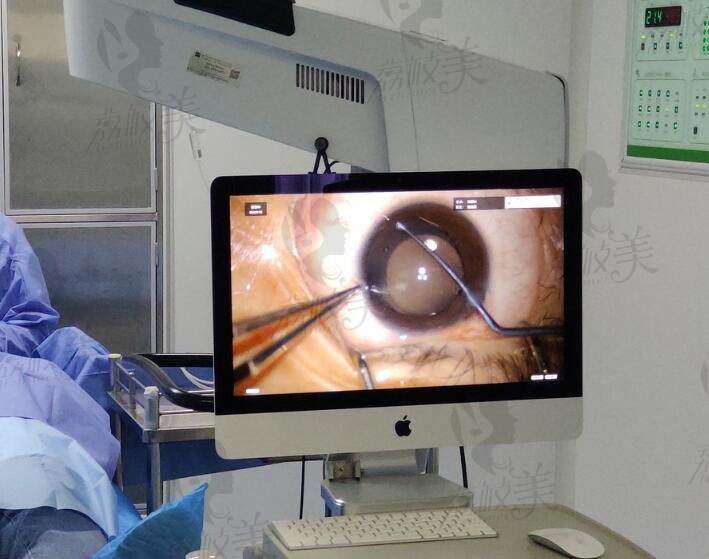 ICL晶体植入手术作为一种可靠的近视矫正方法，已经在范围内得到了广泛应用