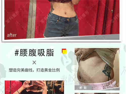 重庆军美腰腹吸脂手术案 例展示