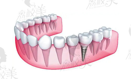 上海瑞泰口腔世紀(jì)公園分院種植牙價(jià)格