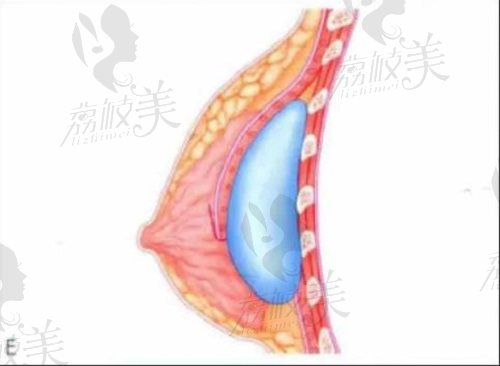 武汉艺星徐国建丰胸技术好