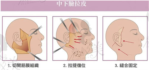 廣州荔醫(yī)整形美容面部拉皮怎么樣