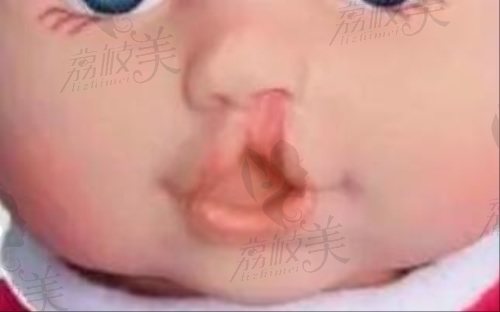 北京画美马群医生唇腭裂修复手术