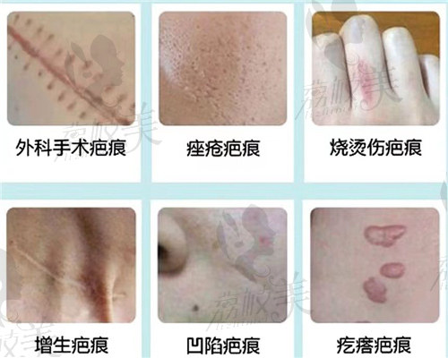 王洪宇医生做激光祛疤的整个治疗过程