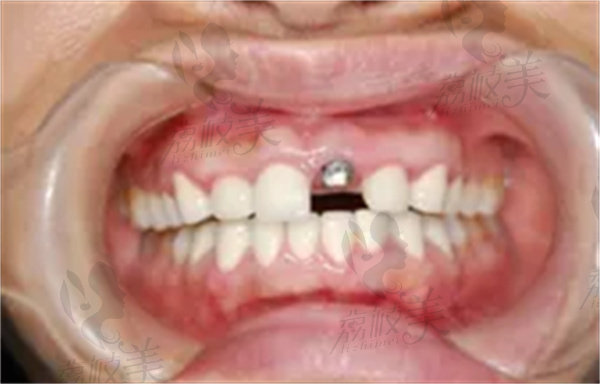 水激光种植牙的技术优势是什么