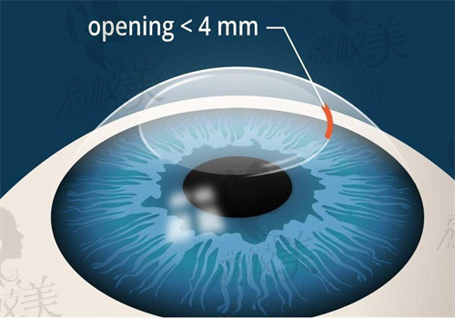 表层激光近视手术优点