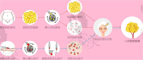 垫鼻子一般价格多少自体软骨