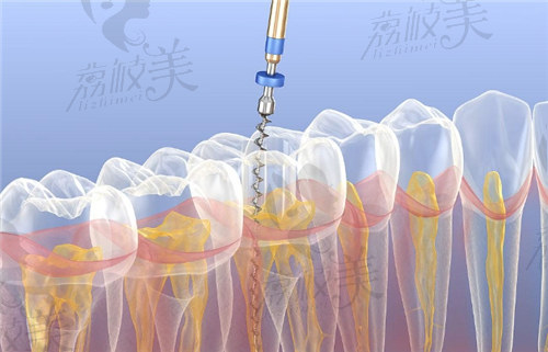 西安根管治療多少錢一顆牙？