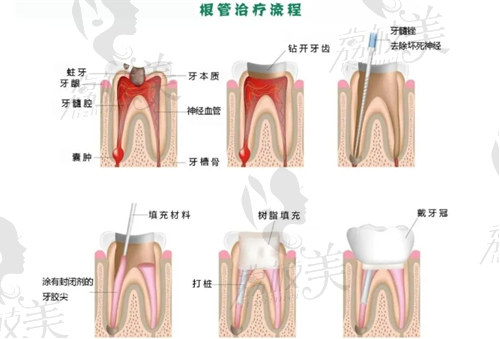 西安做根管治疗好医院有哪些？