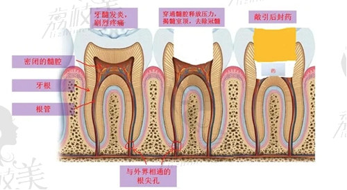 西安根管治療價格