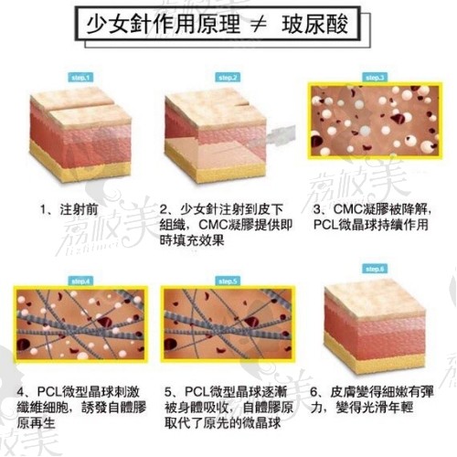 少女针和童颜针填充哪个好?