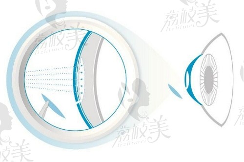 北京爱尔福康眼科医院做近视眼手术技术娴熟