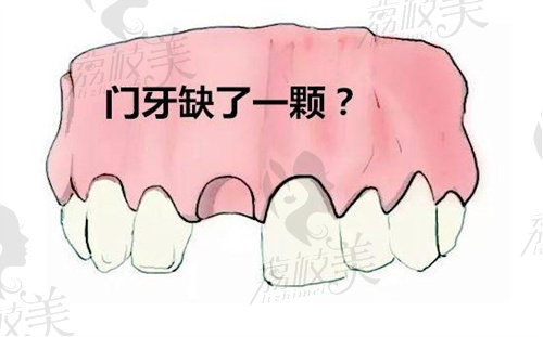 广州种植牙一般多少钱