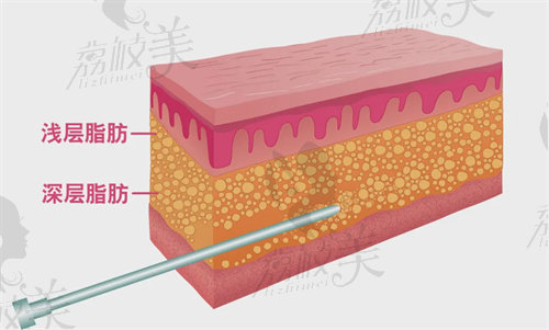 高海燕醫(yī)生吸脂手術(shù)怎么樣