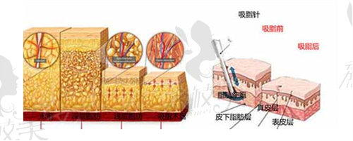 麗都高海燕吸脂