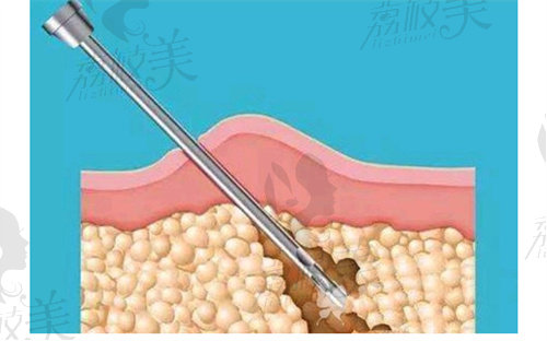 北京丽都高海燕吸脂怎么样