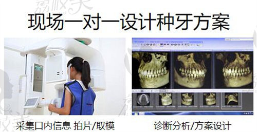 上海泰康拜博口腔松尔种牙方案设计