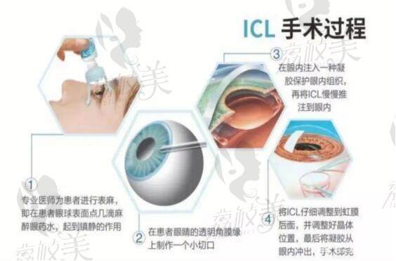 晶体植入手术过程