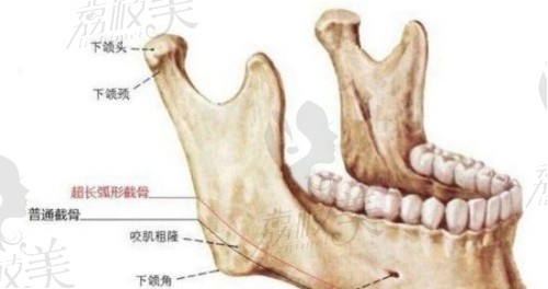 磨骨和削骨哪一个风险小?