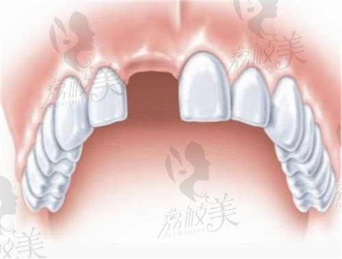 上门牙确实怎么办