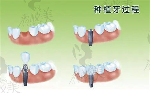 种植牙过程步骤