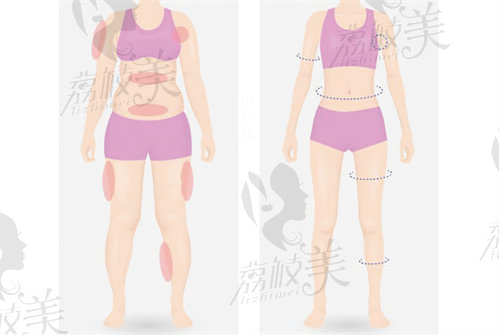 合肥抽脂手術哪家醫(yī)院做的好