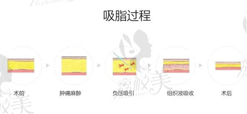 颧骨高磨骨手术需要多少钱