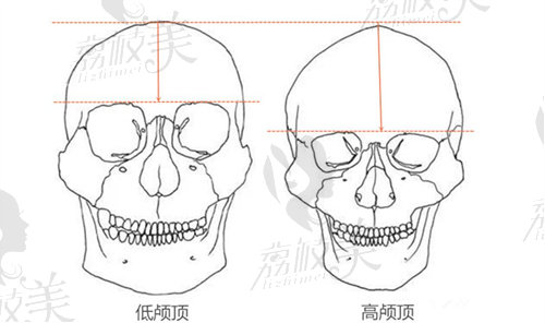 面部轮廓需要多少钱