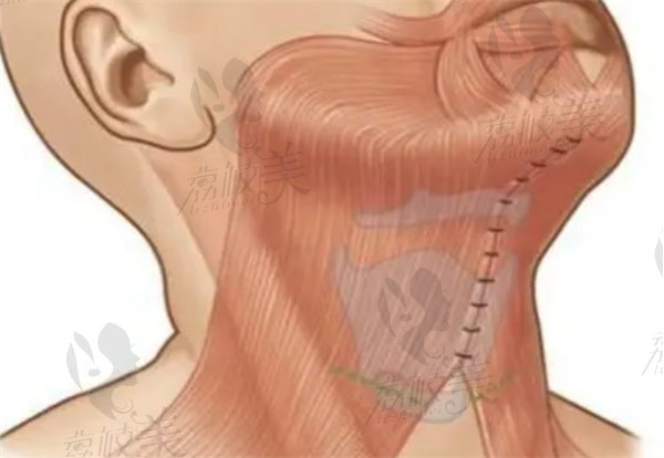 颈阔肌成形术多少钱