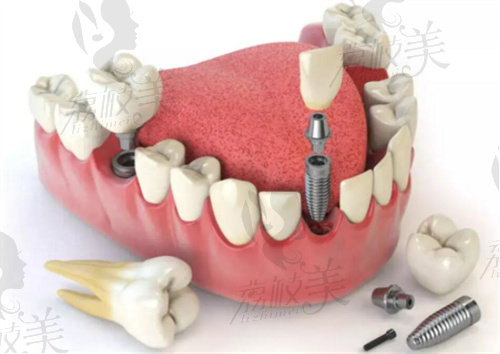 兰州种植牙齿需要多钱一颗？