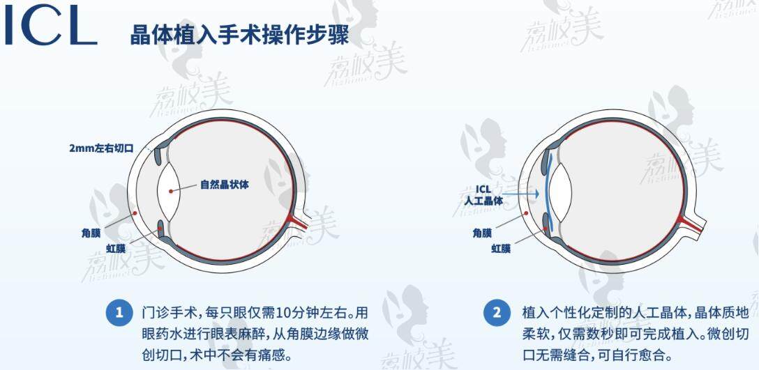 郑州晶体植入近视眼手术价格表