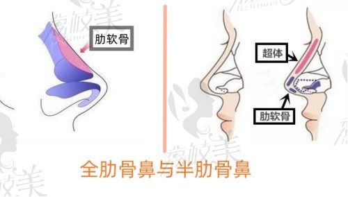 北京米扬丽格鼻修复怎么样呢