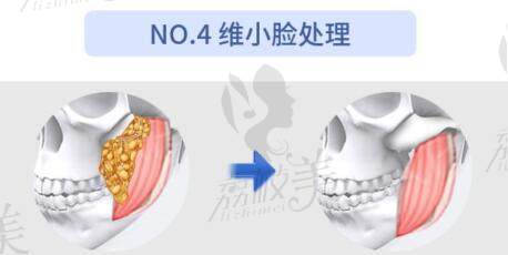 籍建華做長(zhǎng)曲線下頜角手術(shù)費(fèi)用是多少錢(qián)