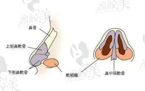 鼻中隔软骨隆鼻后遗症