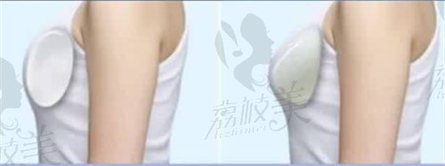 乳房重建也没有必要