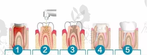 根管治疗的一般步骤