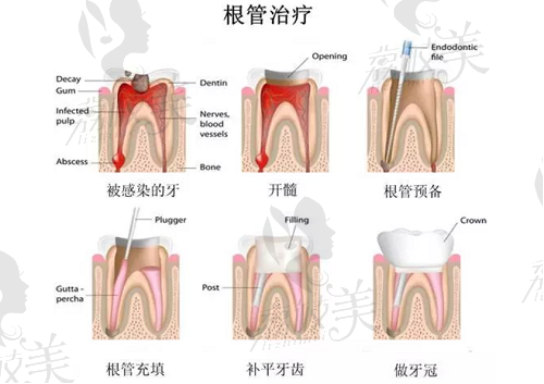 根管治疗的一般步骤